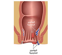 بالتفصيل عمليتي للبواسير عند الدكتور حسن نصر