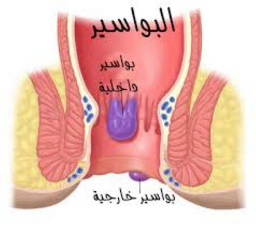 ايهم احسن للبواسير الماء الدافي والا البارد