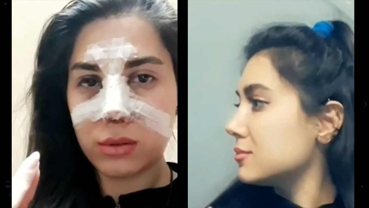 هل عملية تجميل الانف مؤلمة , هل عمليه التجميل مولمه ام لا