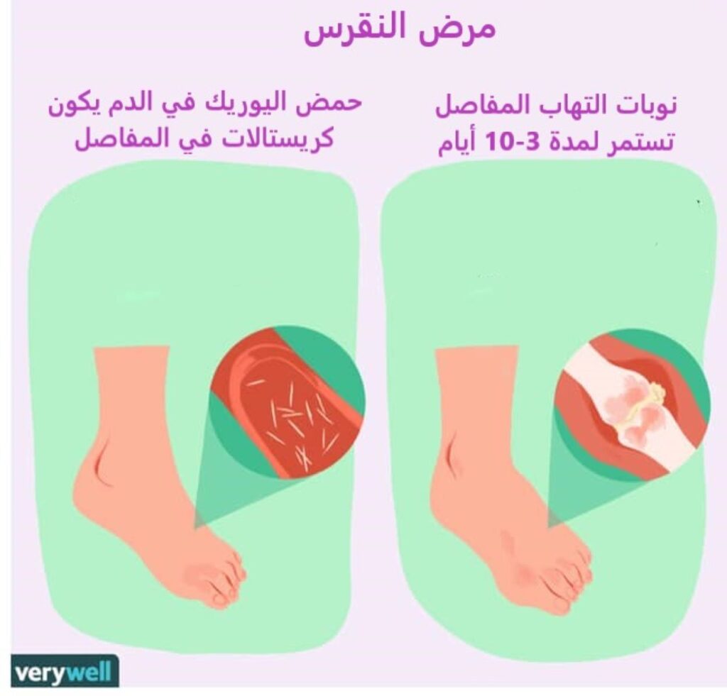 داء النقرس , طريقة علاج النقرس